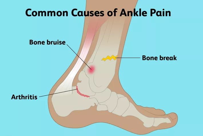 Highest VA Disability Rating for Ankle Pain